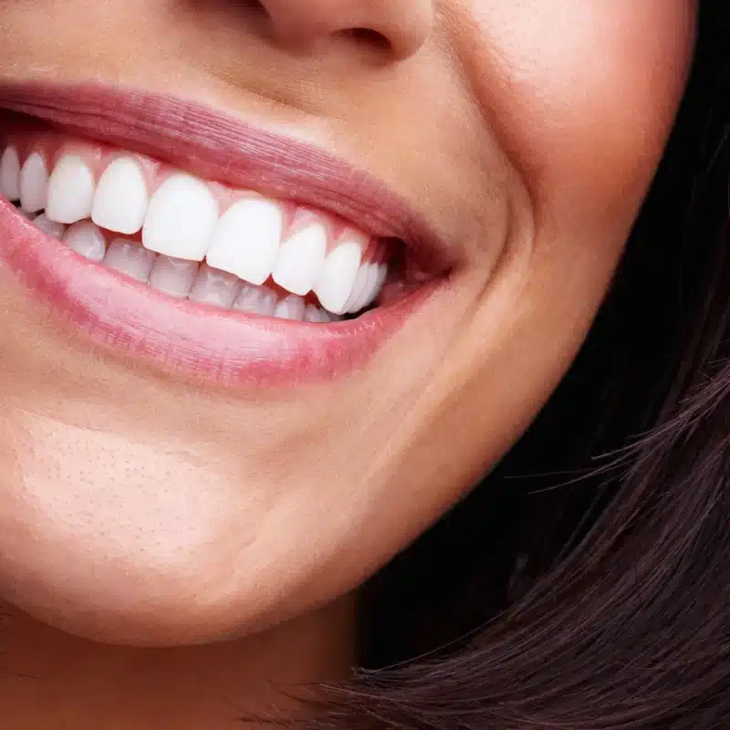 Close-up of a woman smiling showing white teeth after general dentistry appointment and tooth whitening