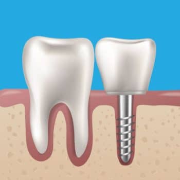 Illustration of natural tooth and dental implant