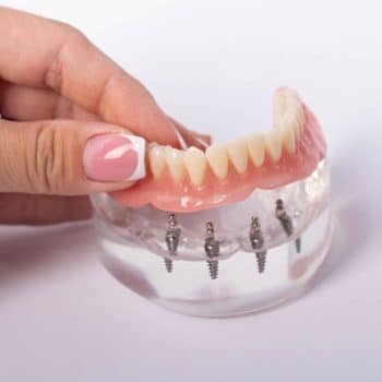 Hand holding dentures above dental implants model.