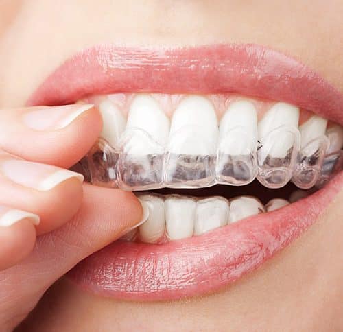 Close-up of clear dental aligners on teeth