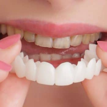 Close-up of smile with clear dental aligners