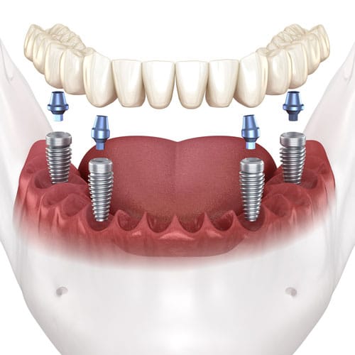 Illustration of dental implants in human lower jaw