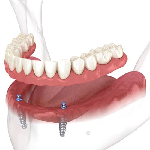 Illustration of dental implant in lower jaw